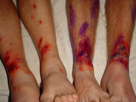 Picture of the Stephens brothers' legs showing effect of the Blister bush